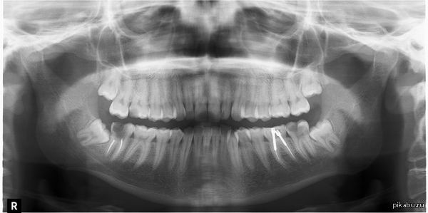 Fitting from the dentist... - My, The photo, X-ray