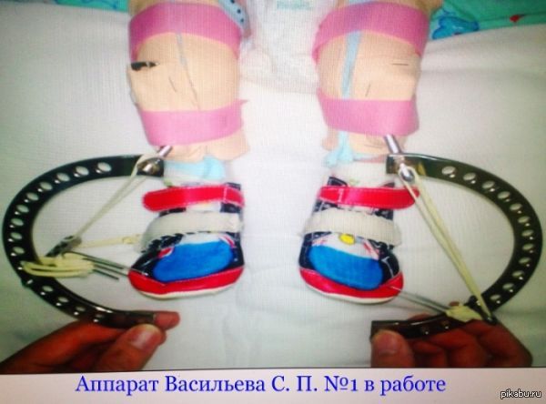 Якутский врач изобрел средство, помогающее избавить детей от косолапости